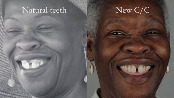 Newsletter 53 showing the making and fitting of ultra life-like dentures for Valena