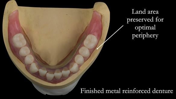 Finished metal reinforced lower denture finished to the land area of the model for optimal polished surfaces