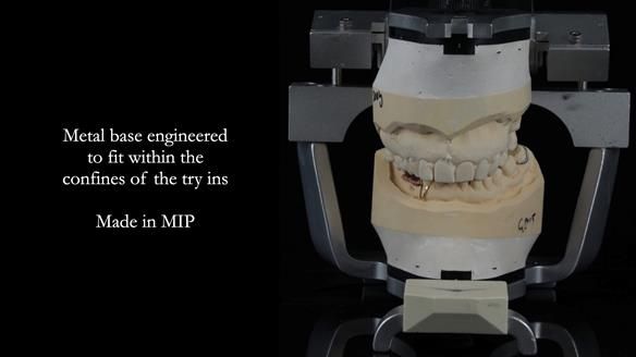 Finlay's Newsletter 61 provision of a lower unilateral free end saddle metal based partial denture for Joyce