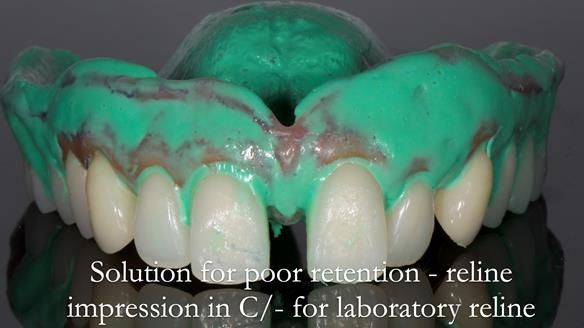 Newsletter 53 showing the making and fitting of ultra life-like dentures for Valena