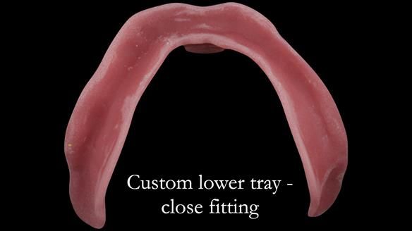 Complete denture Class II div 2 deep overbite Newsletter 39