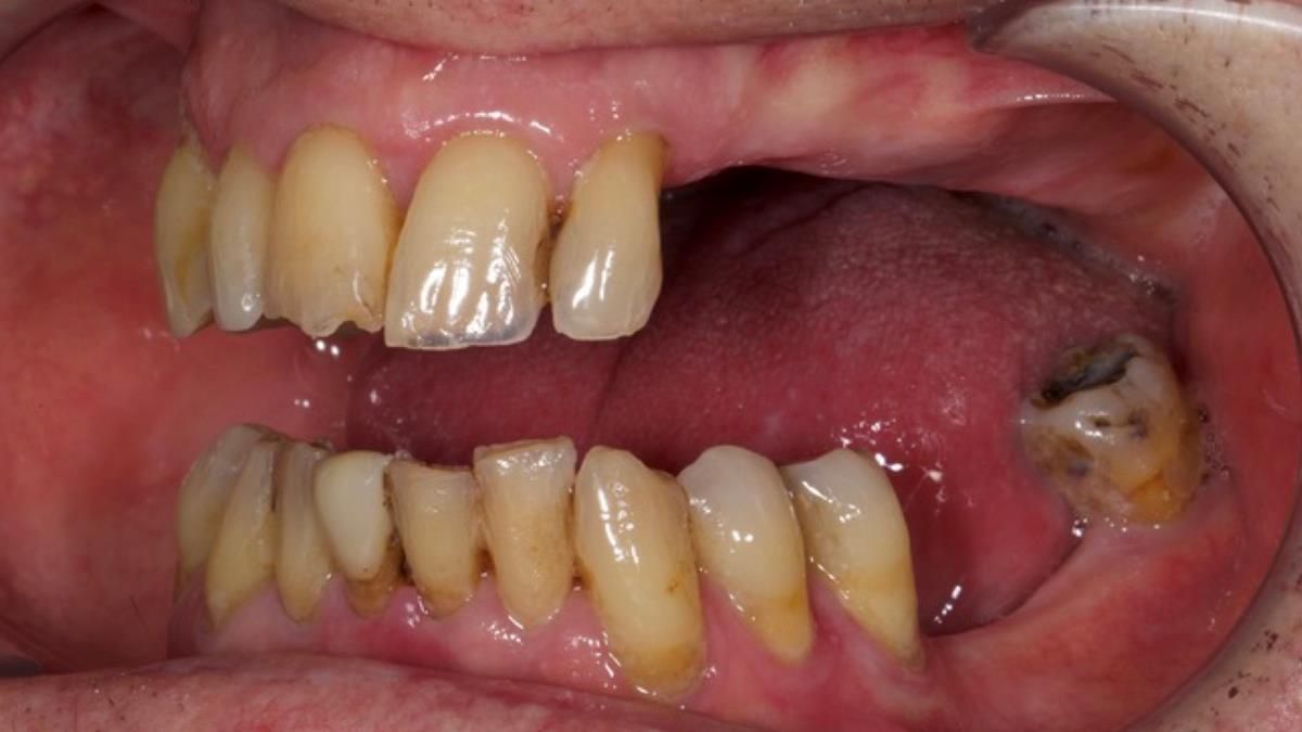 Newsletter 89 – Simon: A Challenging Kennedy Class II Division 1 Upper CoCr Partial Denture with a High Smile Line