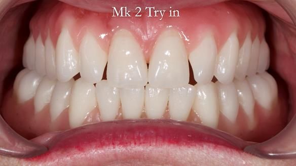 Replacing Madeline’s Complete denture FULL PROTOCOL