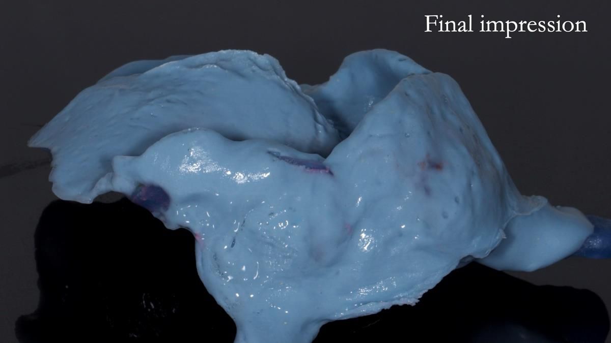 Newsletter 89 – Simon: A Challenging Kennedy Class II Division 1 Upper CoCr Partial Denture with a High Smile Line