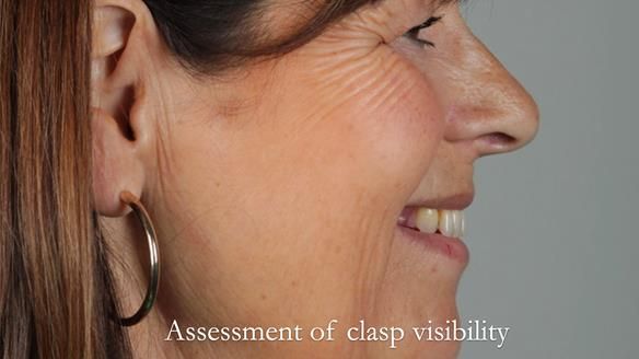 Newsletter 56 showing the making and fitting of a bilateral free end saddle upper removable partial denture (RPD) for patient with pemphigus