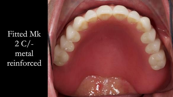 Newsletter 52 Managing Jo’s failing dentition with extractions and Mk 1/Mk 2 complete upper dentures and lower partial dentures FULL PROTOCOL