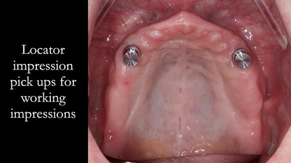 Newsletter 57 showcases the making and fitting process of implant-supported complete dentures for Alisdair