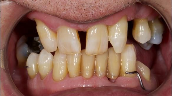 Newsletter 86 Peter the Architect — precision removable partial dentures case study