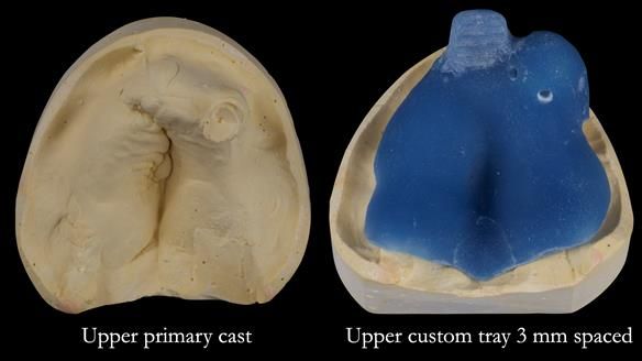 Newsletter 55 Provision of metal based partial dentures for Zephyrine with a repaired cleft lip and palate