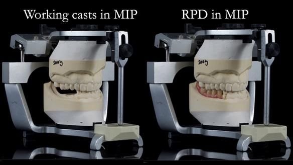 Finlay's Newsletter 61 provision of a lower unilateral free end saddle metal based partial denture for Joyce