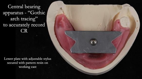 Finlay's Newsletter 59 Ultra hard partial dentures made for Gill