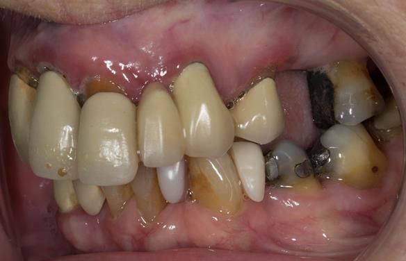 Figure 5 Pre - treatment. Failing upper teeth