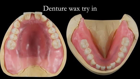 Newsletter 53 showing the making and fitting of ultra life-like dentures for Valena
