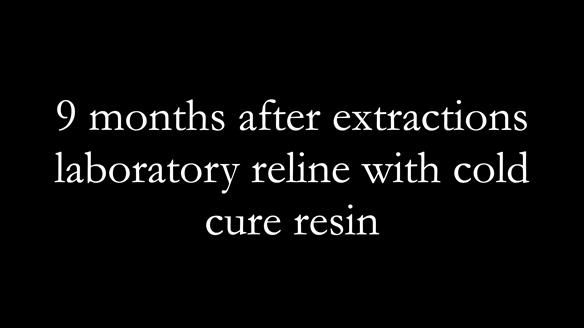 Finlay's Newsletter 62 provision of extractions and metal based complete dentures for Rafique