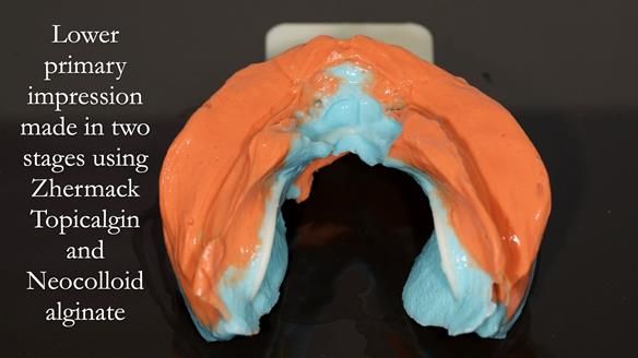 Managing poor implant positioning with complete dentures and Locator attachments - full protocol Newsletter 41