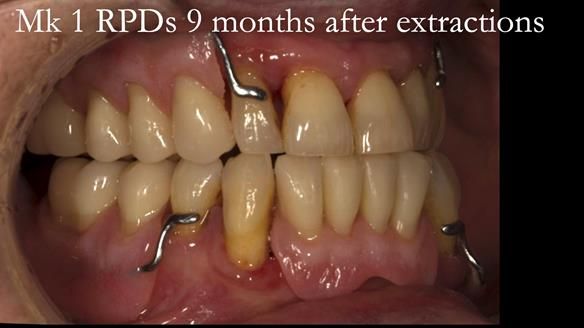 Finlay's Case Study Newsletter 40 - Immediate Mk 1 RPD to Definitive Mk 2 RPD - full protocol