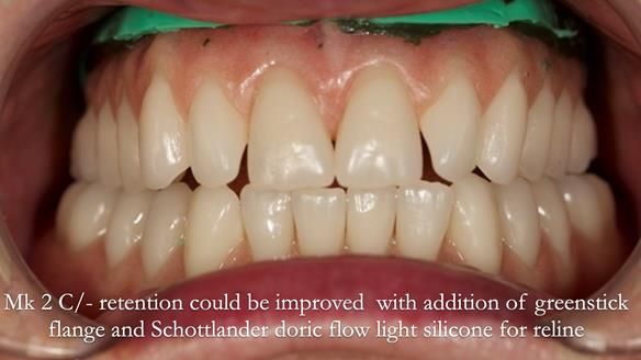 Replacing Madeline’s Complete denture FULL PROTOCOL
