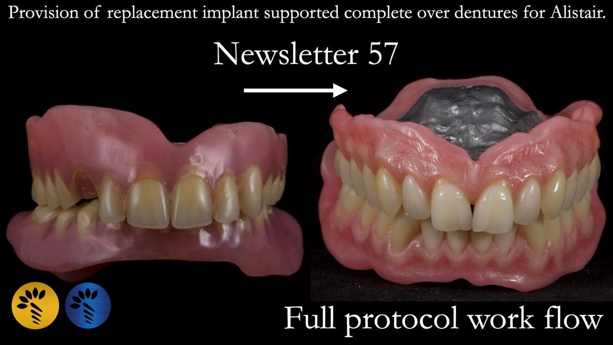 Newsletter 57 showcases the making and fitting process of implant-supported complete dentures for Alisdair