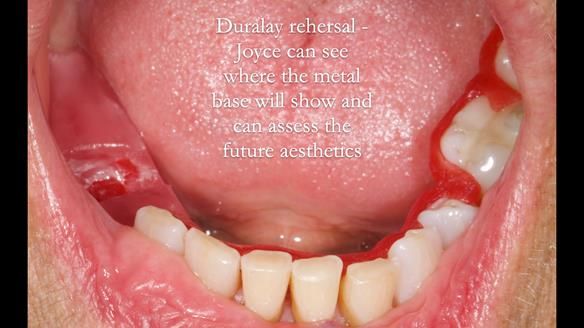 Finlay's Newsletter 61 provision of a lower unilateral free end saddle metal based partial denture for Joyce
