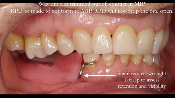 Finlay's Newsletter 61 provision of a lower unilateral free end saddle metal based partial denture for Joyce