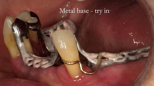 Finlay's Case Study Newsletter 40 - Immediate Mk 1 RPD to Definitive Mk 2 RPD - full protocol