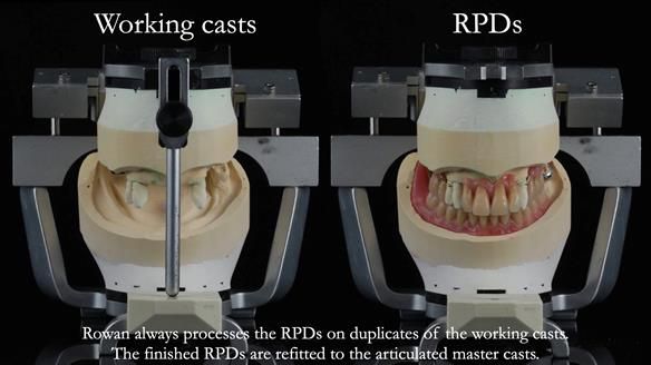 Finlay's Newsletter 59 Ultra hard partial dentures made for Gill