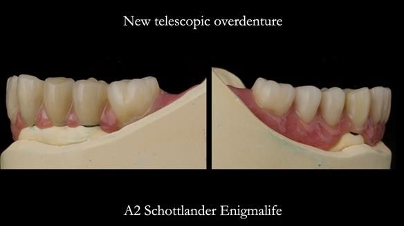 Newsletter 76: Jackie’s case – Telescopic overdenture & precision RPD (the tricky truth!)