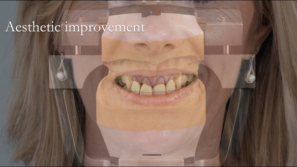  Figure 17 Photograph of the patient's smile superimposed on the mounted working casts for the immediate dentures. Lines drawn on the cast for ideal replacement tooth positions.