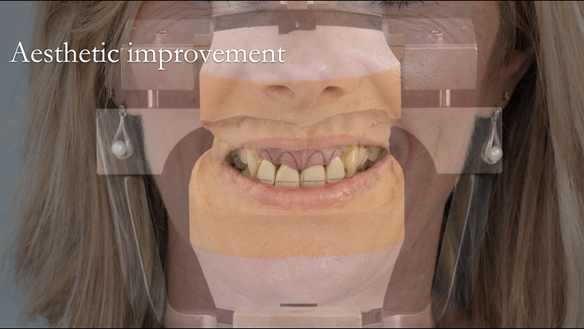 Figure 17 Photograph of the patient's smile superimposed on the mounted working casts for the immediate dentures. Lines drawn on the cast for ideal replacement tooth positions.