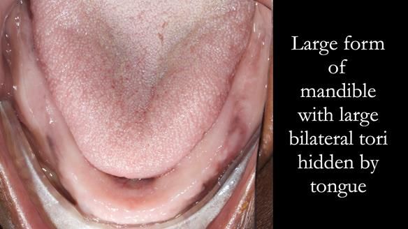 Newsletter 53 showing the making and fitting of ultra life-like dentures for Valena