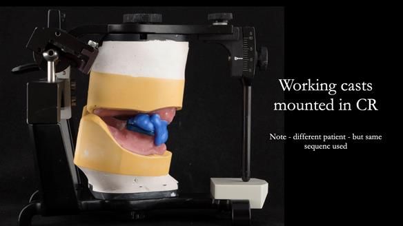 The lower working cast is attached to the lower member of the articulator using the central bearing apparatus