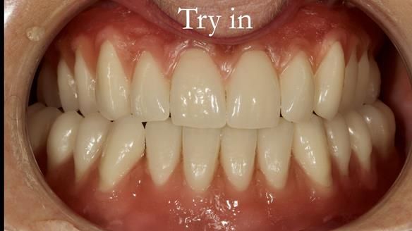 Try in the occlusion is checked first. No occlusal errors are found when using the gothic arch tracing