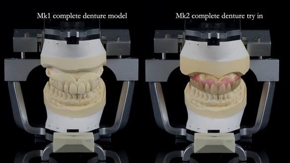 Newsletter 77: Jeremy’s case – immediate complete upper denture