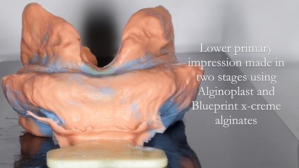 Newsletter 80 - Gordon’s dentures: the one case in 1,000 where my technique failed