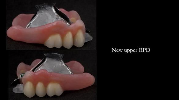 Newsletter 76: Jackie’s case – Telescopic overdenture & precision RPD (the tricky truth!)
