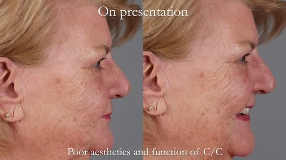 Replacing Madeline’s Complete denture FULL PROTOCOL