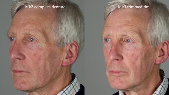 Newsletter 77: Jeremy’s case – immediate complete upper denture