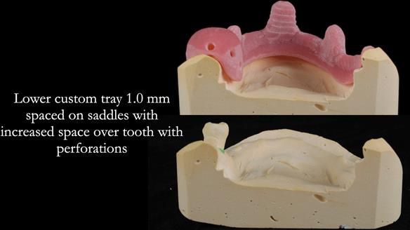 Finlay's Newsletter 59 Ultra hard partial dentures made for Gill