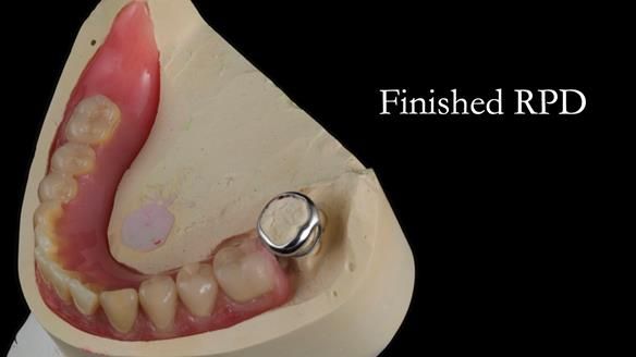 Finlay's Newsletter 59 Ultra hard partial dentures made for Gill