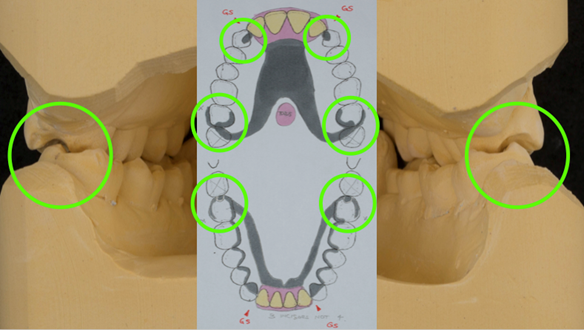  Figure 57 Assessment of occlusal space of the check casts