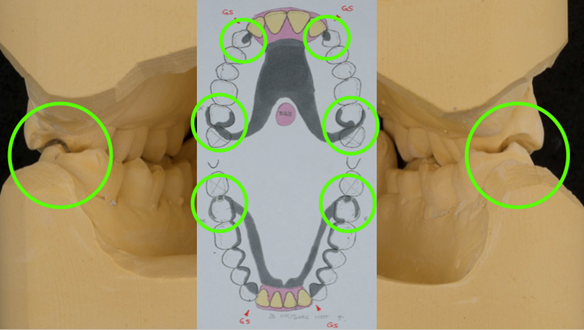 Figure 57 Assessment of occlusal space of the check casts