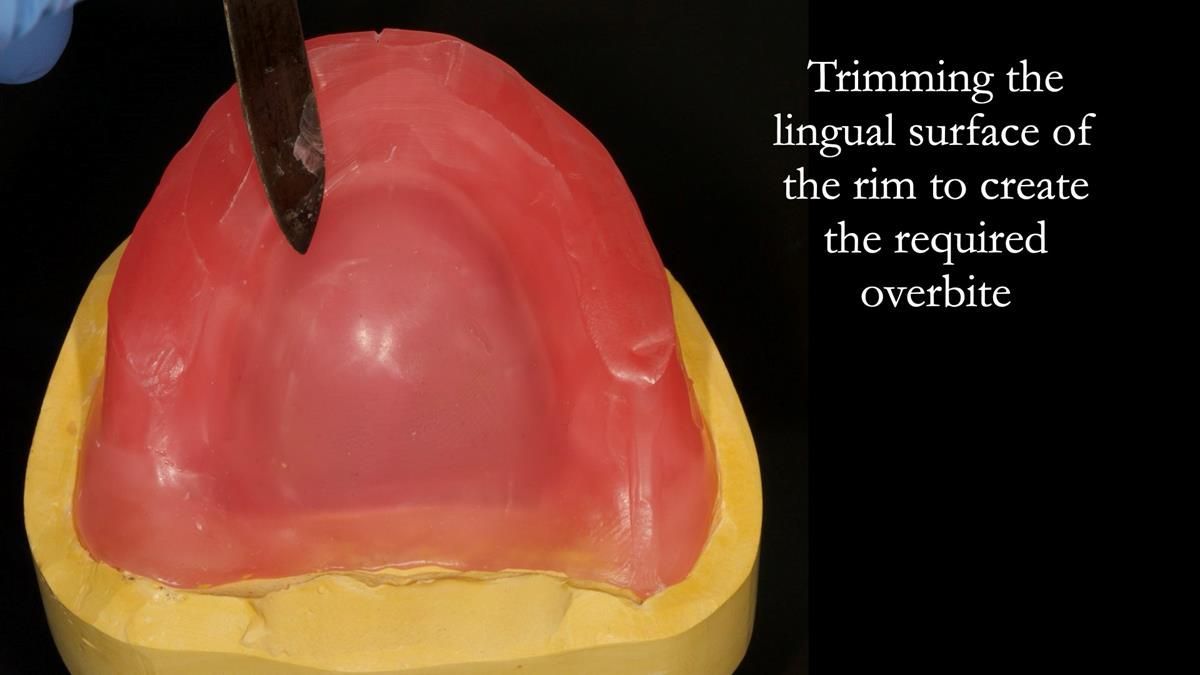Newsletter 87 – Father Peter: A Partial Denture that needed Minor Miracle