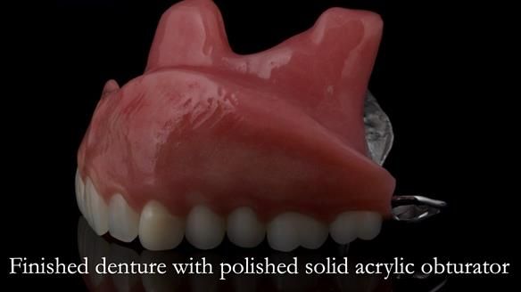 Upper metal base partial denture/occlusal stabilisation splint/obturator - full protocol