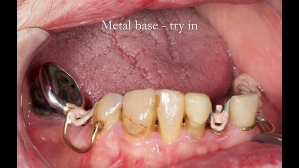 Newsletter 55 Provision of metal based partial dentures for Zephyrine with a repaired cleft lip and palate