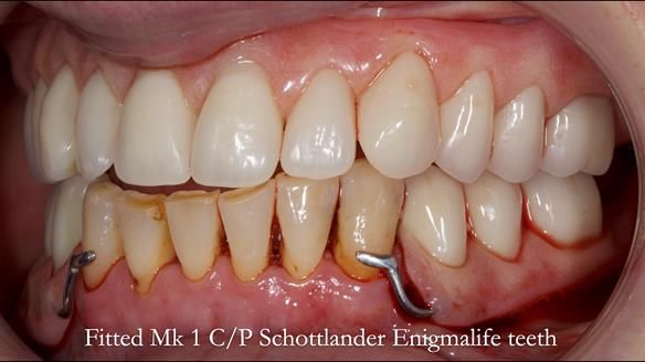 Newsletter 52 Managing Jo’s failing dentition with extractions and Mk 1/Mk 2 complete upper dentures and lower partial dentures FULL PROTOCOL