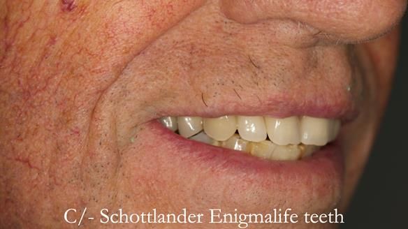 Newsletter 54 case presentation upper complete denture and lower Scandinavian designed hygienic partial denture for David