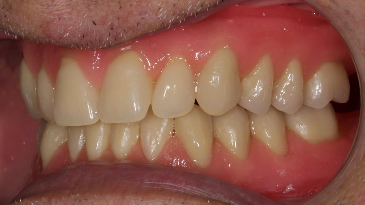 Fin’s Newsletter 88 — Complete dentures - full protocol… he rearranged his own teeth!