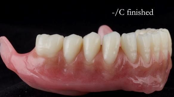 Managing poor implant positioning with complete dentures and Locator attachments - full protocol Newsletter 41