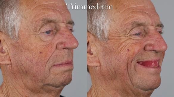 Newsletter 54 case presentation upper complete denture and lower Scandinavian designed hygienic partial denture for David
