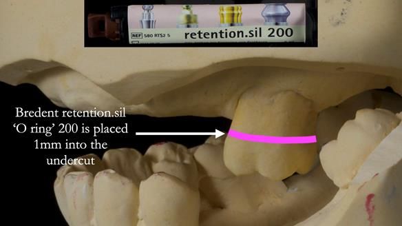 Finlay's Newsletter 58 Gasket upper partial denture for Zoe